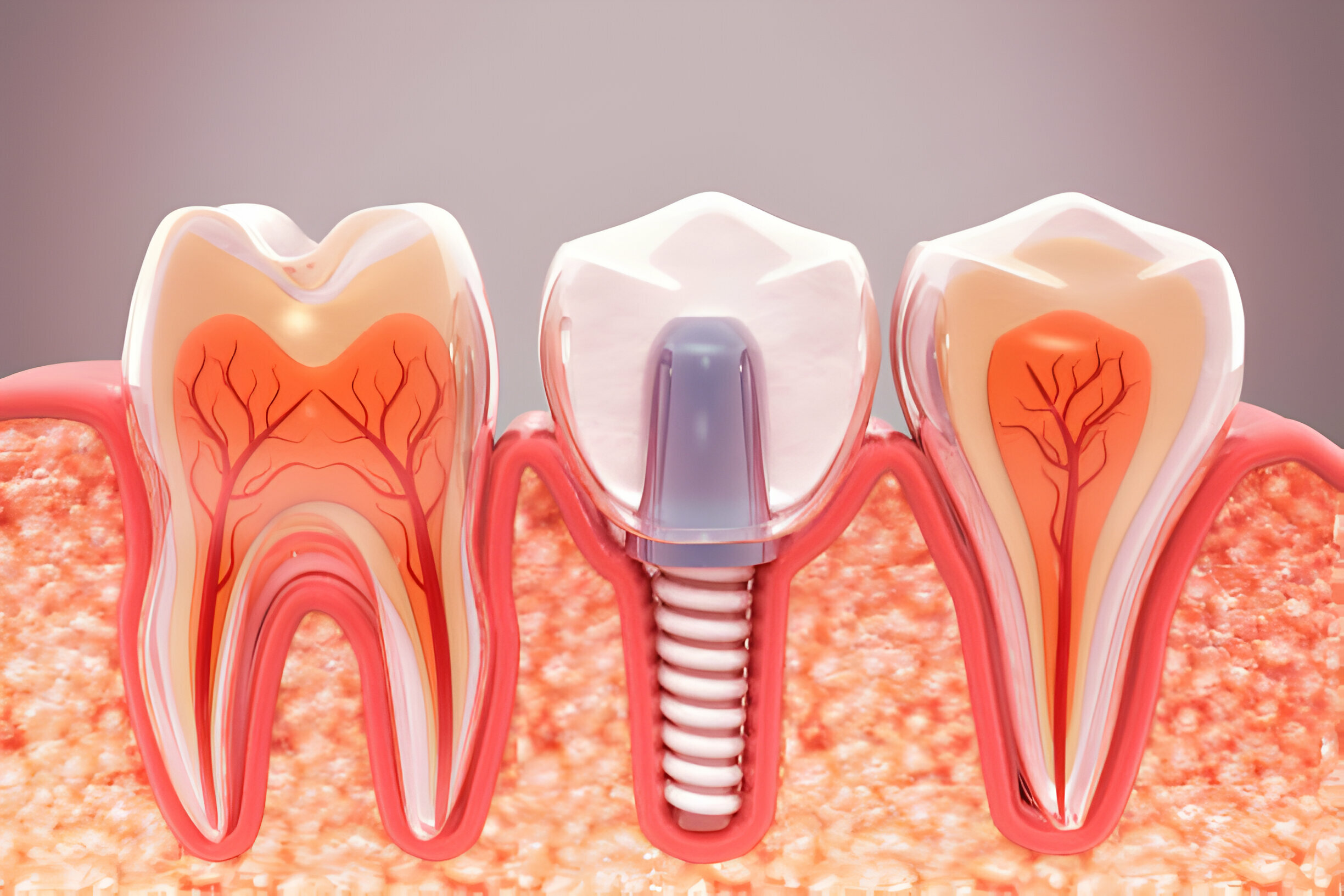 How Dental Implants Can Boost Your Confidence and Quality Of Life?_1