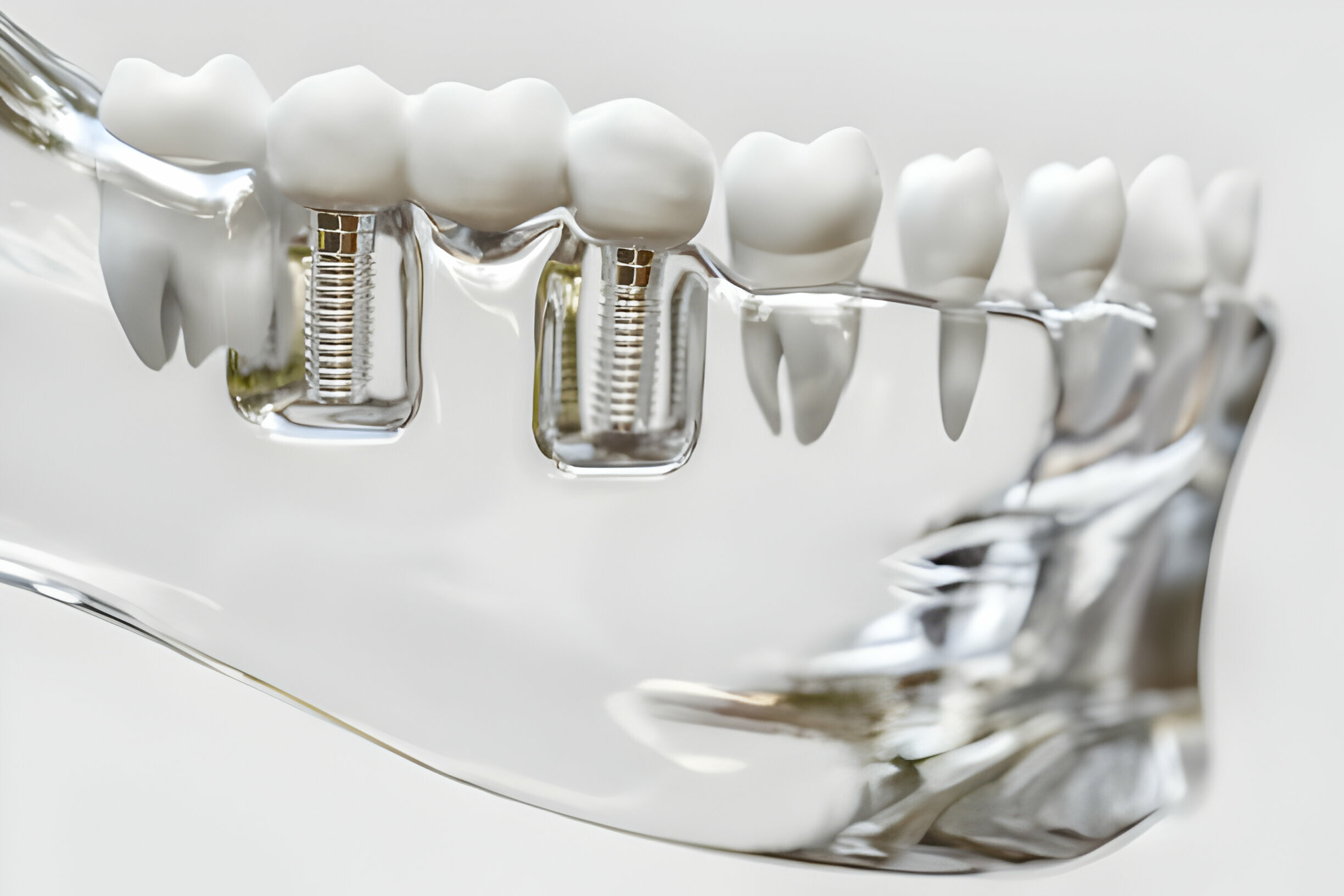 How Dental Implants Can Boost Your Confidence and Quality Of Life?_3