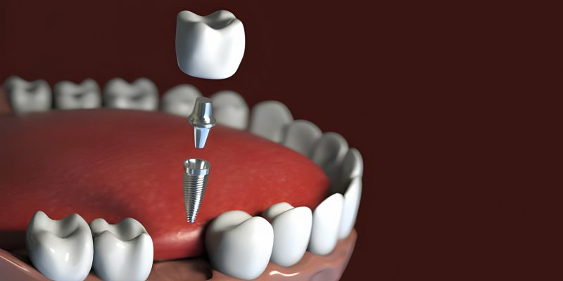 How Dental Implants Can Boost Your Confidence and Quality Of Life?_FI