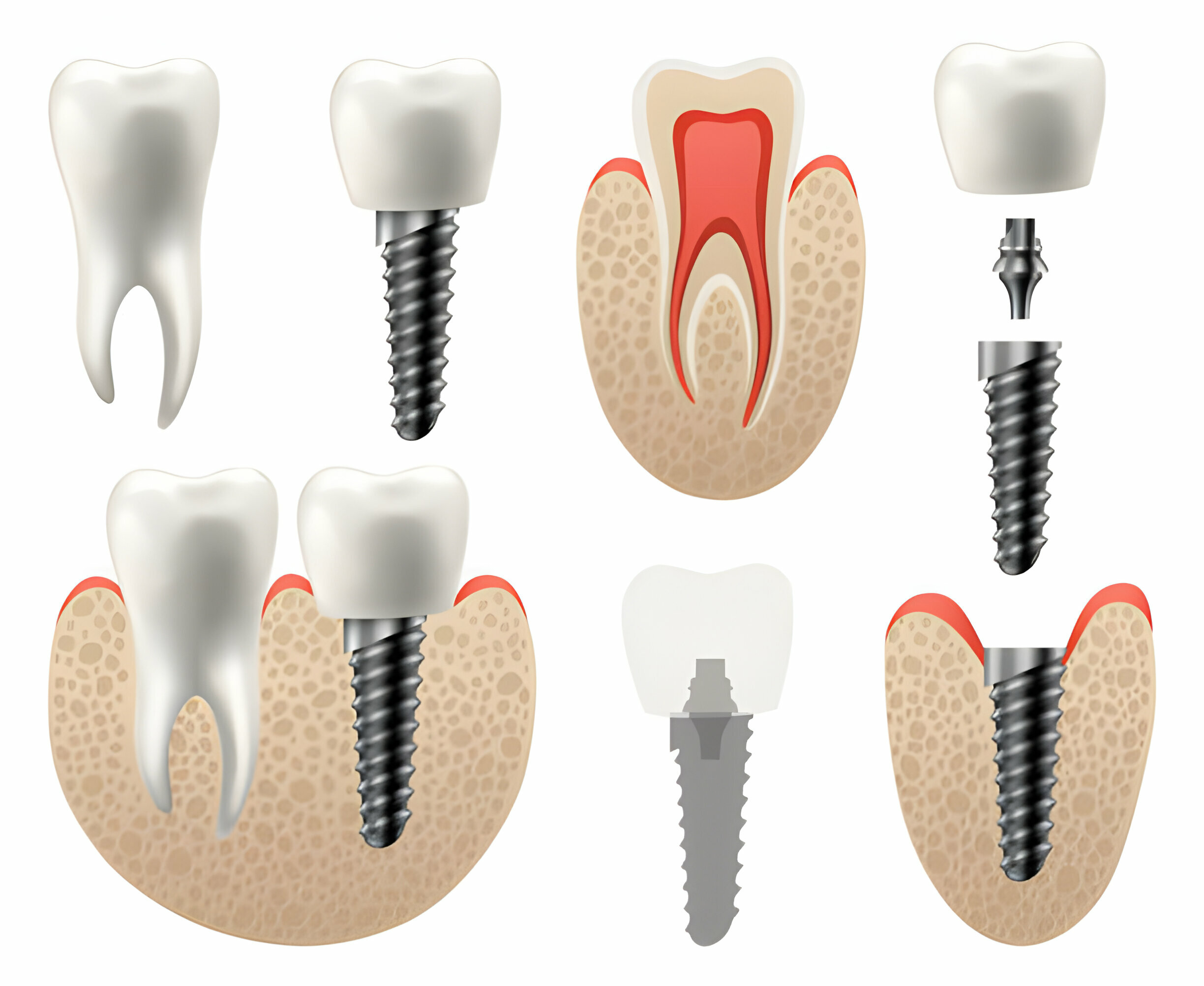 From Consultation to Completion: The Journey of Same-Day Dental Implants_1