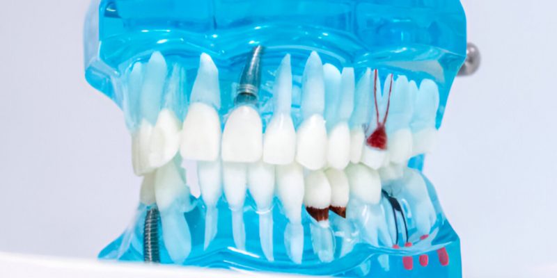 How Root Canal Therapy Can Save Your Tooth and Improve Oral Health_FI