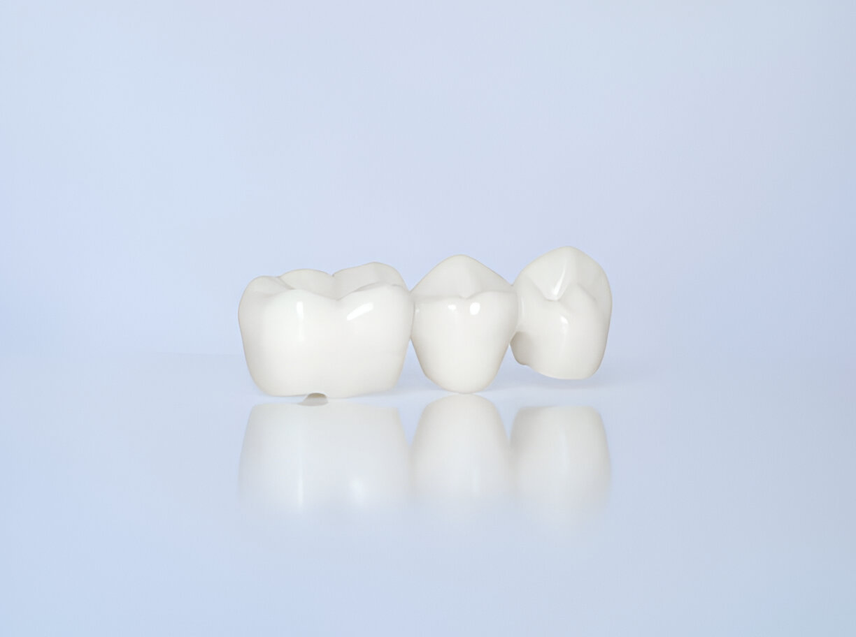 Restore Your Smile with Dental Crowns at Cane Bay Family Dentistry, Summerville,SC_1