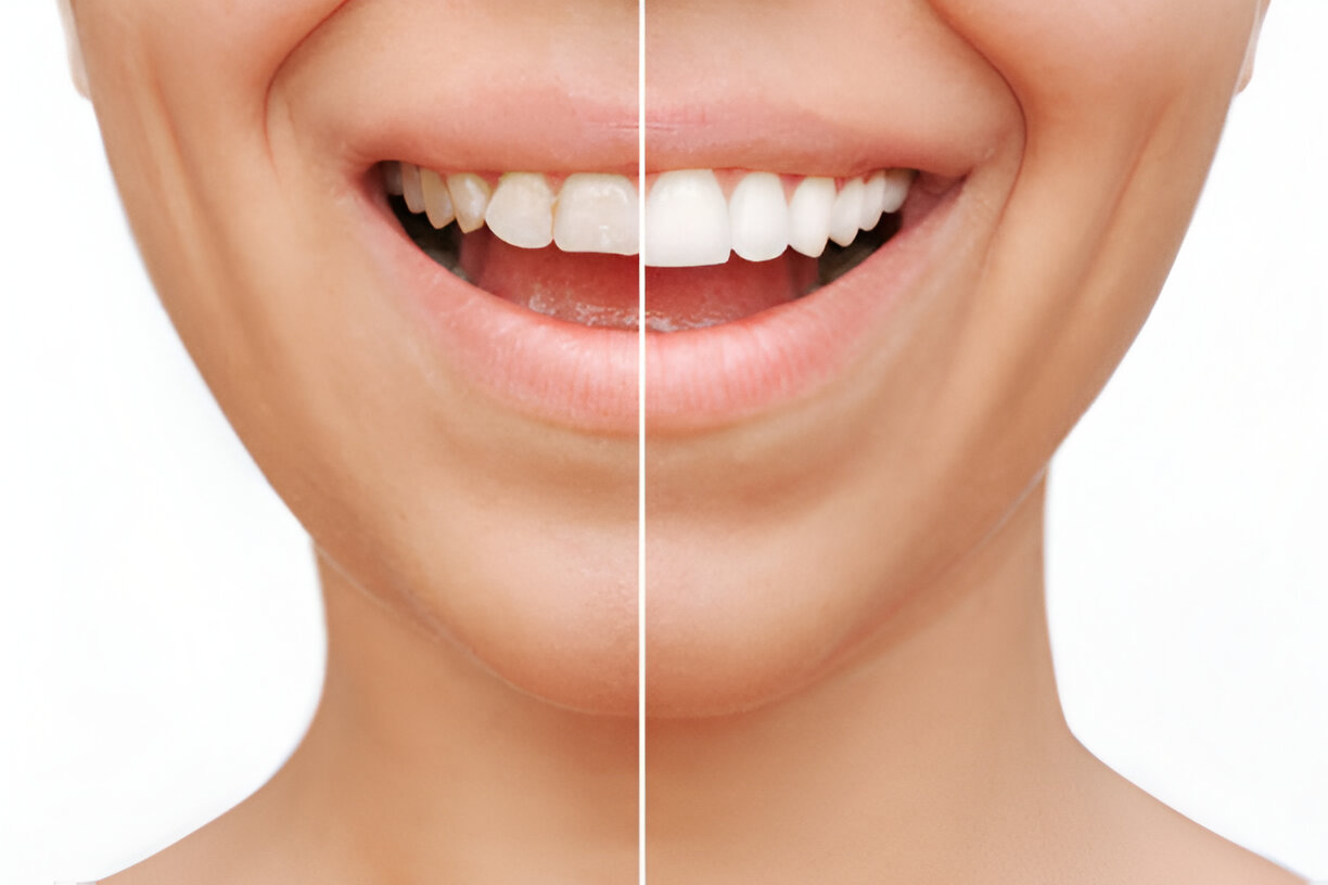 Restore Your Smile with Dental Crowns at Cane Bay Family Dentistry, Summerville,SC_2