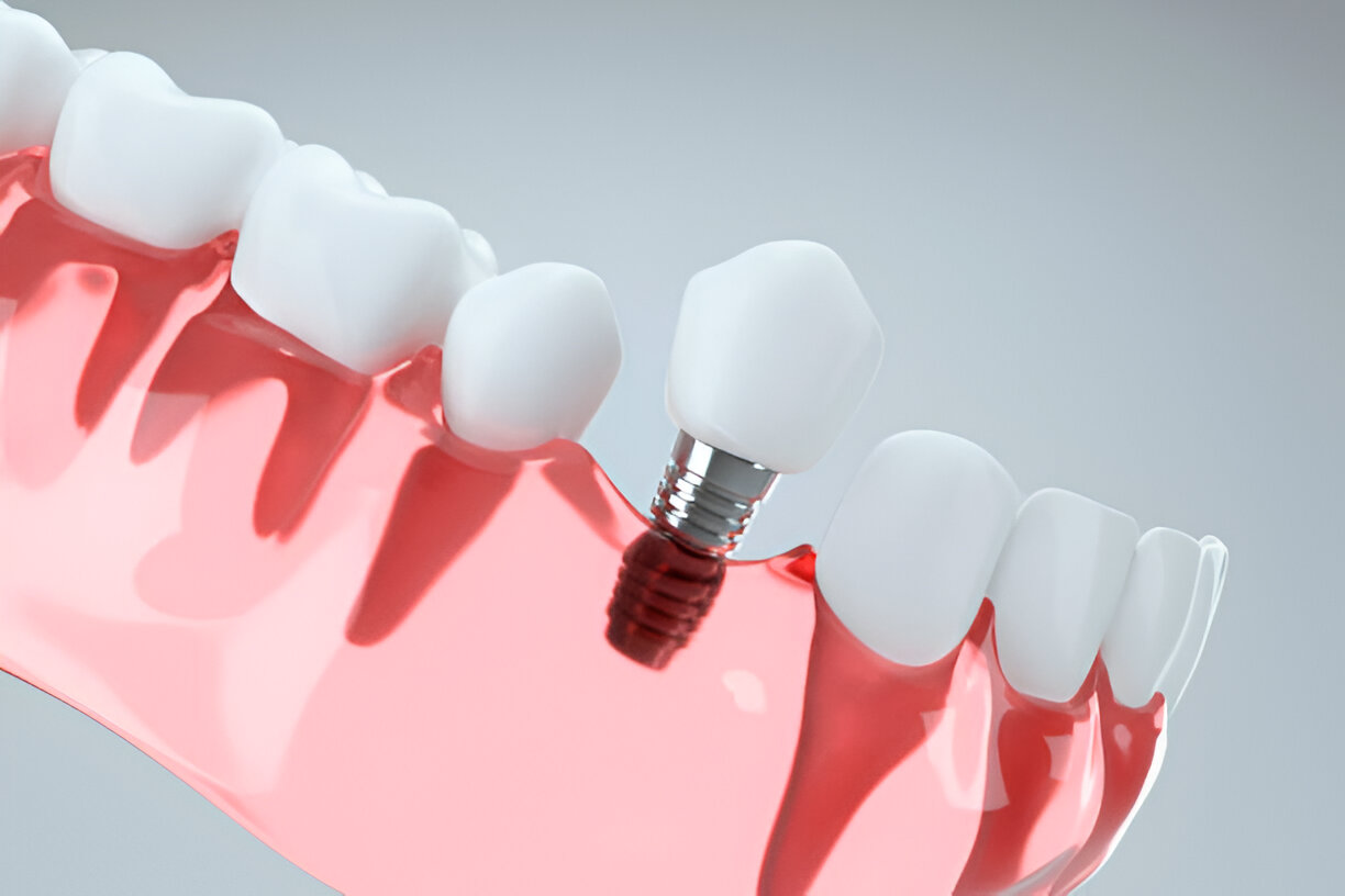 Dental Implants in Summerville, SC: Why Cane Bay Family Dentistry Is Your Best Choice_2