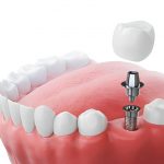 Dental Implants in Summerville, SC: Why Cane Bay Family Dentistry Is Your Best Choice_FI