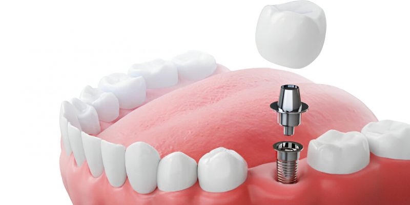 Dental Implants in Summerville, SC: Why Cane Bay Family Dentistry Is Your Best Choice_FI