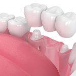 Cane Bay Family Dentistry’s Expert Guide to Types of Crowns for Restorative Dentistry in Summerville, SC_FI