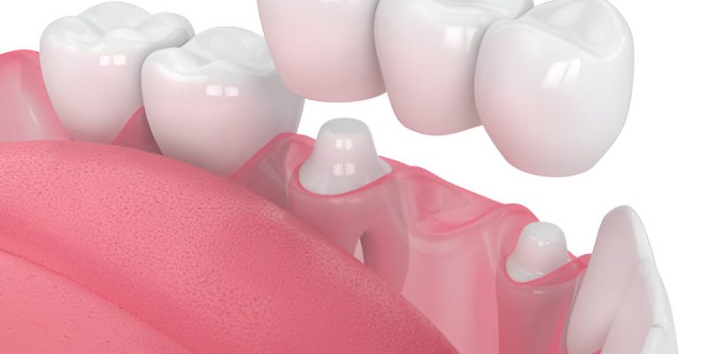 Cane Bay Family Dentistry’s Expert Guide to Types of Crowns for Restorative Dentistry in Summerville, SC_FI